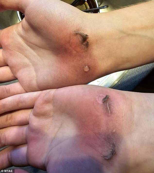 Parents at a Pennsylvania school are furious over 'extreme' school volleyball practice that left their children covered in bruises and blisters