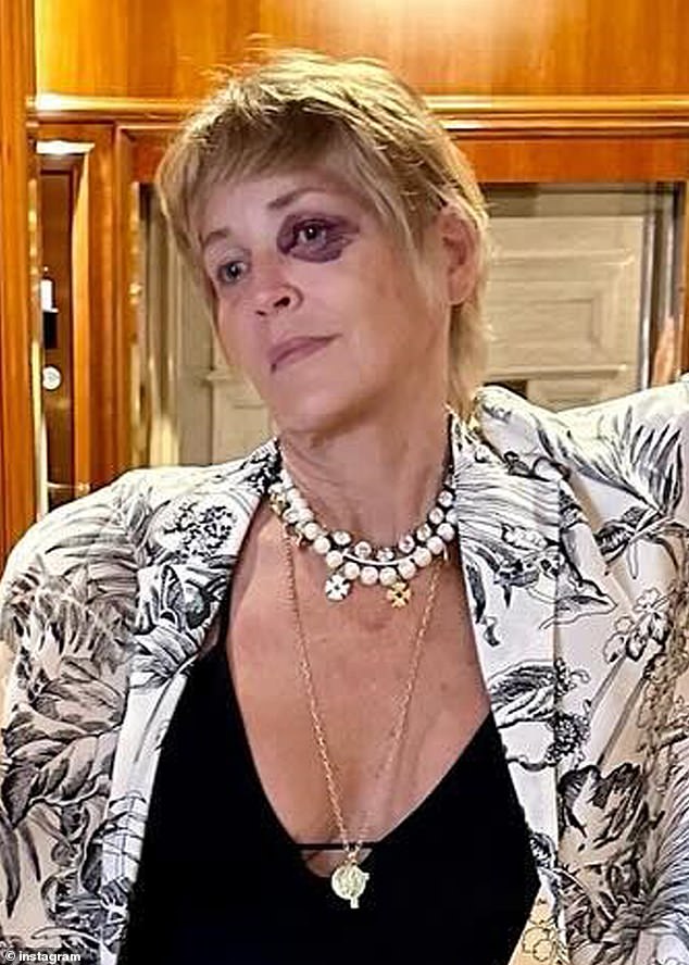 Sharon, 66, shared a photo of the bruises on July 31. She said she fell and hit her face on a marble floor while searching for a toilet at night.