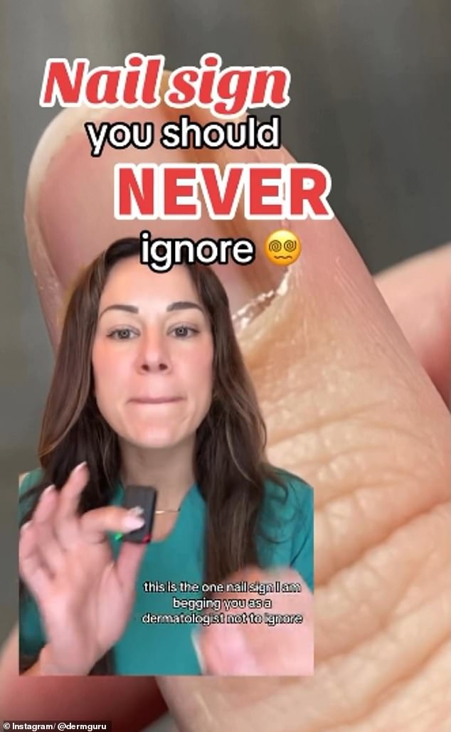 Dermatologist Lindsey Zubritsky, or @dermguru on Instagram, warned her 1.2 million followers to watch out for the streaky dark spots under the nails, which could be a form of melanoma