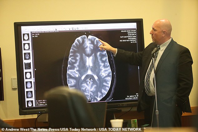 Dr. Thomas Coyne, a neuropathologist and medical examiner, testified in court Tuesday that he found no damage to Wilson's skull or brain.