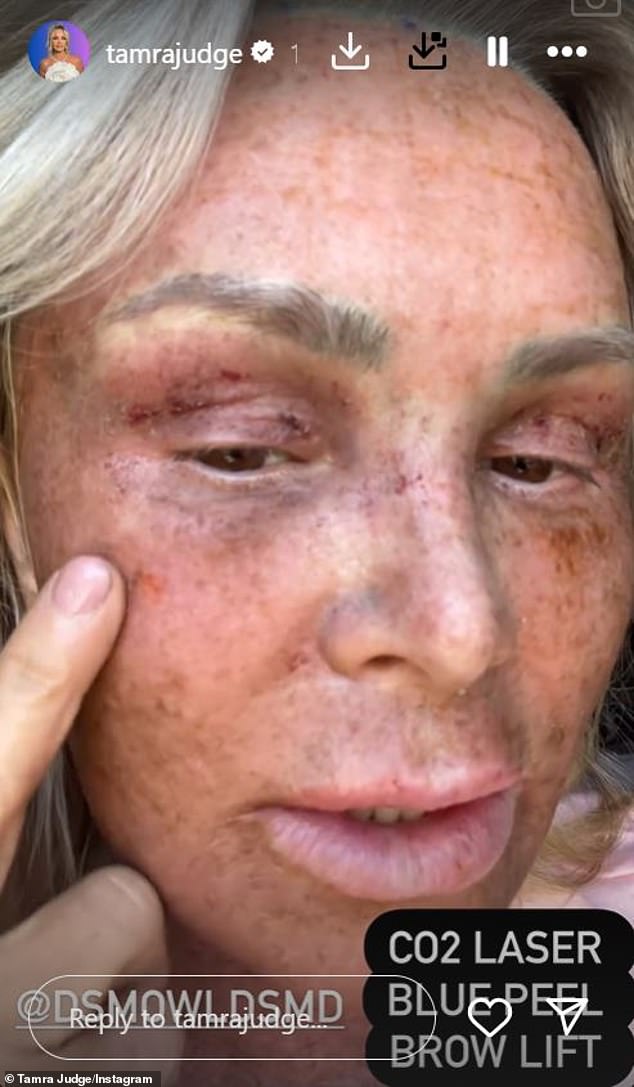 The Real Housewives of Orange County personality is recovering from multiple cosmetic surgeries, including a brow lift, CO2 laser and blue peel