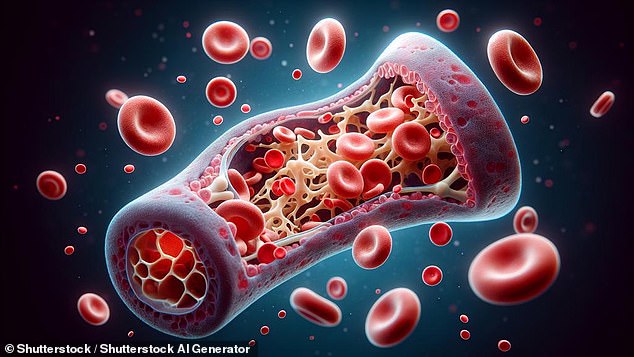 A stem cell or bone marrow transplant replaces damaged blood cells with healthy ones. It can be used to treat conditions that affect blood cells, such as leukemia and lymphoma (artist's impression)