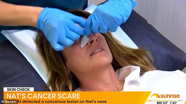 During a routine skin check, Nat Barr was diagnosed with skin cancer on her nose, and she spoke about it on Sunrise at the time