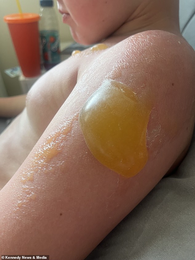 But a mishap with sunscreen left the 10-year-old looking like he had 'hot water thrown on him', with huge yellow blisters and large areas of his skin peeling off