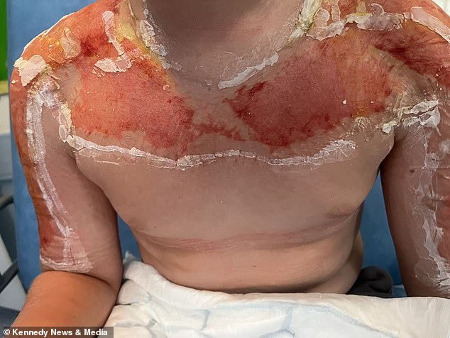 After calling NHS 111 for help, he was eventually admitted to the Queen's Medical Centre in Nottingham, where he was treated for sunburn and underwent surgery to have his blisters drained and cleaned.