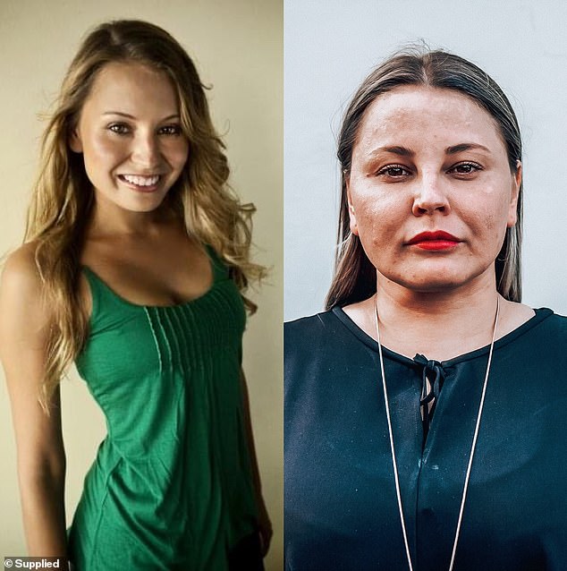 She suffered from open sores on her face that would not heal, excessive weight gain overnight, facial changes and extreme fatigue. Four years later an MRI discovered a 6mm tumor growing in the pituitary gland of her brain (before and after pictured)