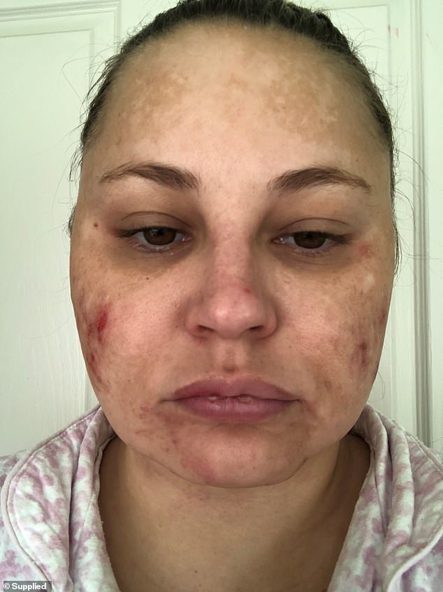 Ania, now 41, underwent surgery to remove the tumor, which was successful, but she was left with adrenal insufficiency because the body was no longer producing enough cortisol on its own