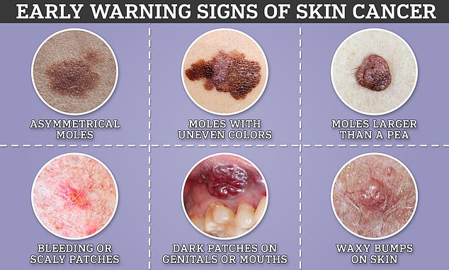 Skin cancer symptoms range from mild to obvious, but experts warn that it's crucial to treat cases early to prevent them from spreading or developing further.