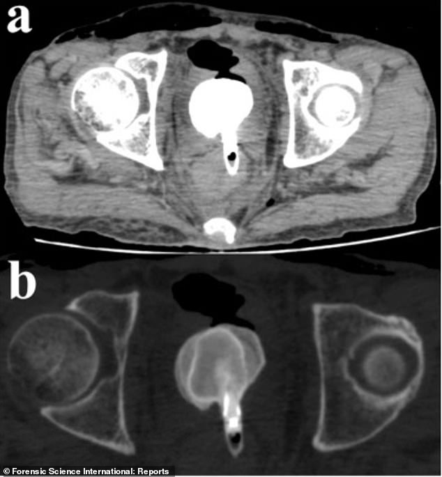 The above CT scan shows the eye line near the patient's bladder. The eyeliner tube was attached to a bladder stone, which was likely formed from sediment and bacteria found on the tube