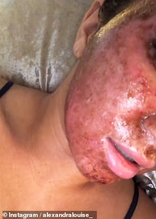 The reality star shows off her lasered skin just days after the treatment