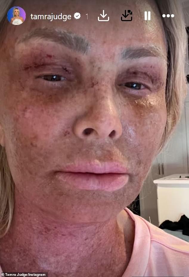 Real Housewives of Orange County star Tamra vowed not to go under the knife again after a 'brutal' brow lift, CO2 laser treatment and chemical peel left her in excruciating pain