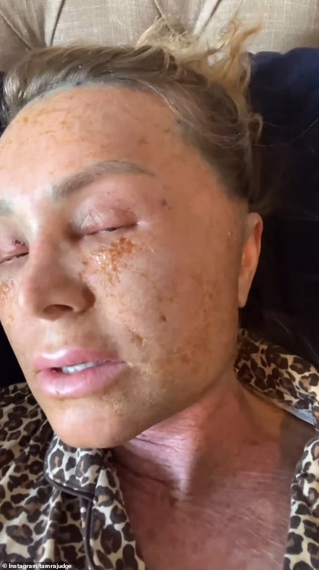 On Sunday, she shared an update on the third day of her recovery, with her face looking much more swollen and her skin starting to peel. She told her followers that it felt like her skin was 