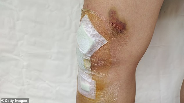 Around 3.8 million patients a year are treated for wounds by the NHS (file image)