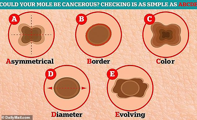 Annual full body skin checks are recommended, but people can perform periodic self-checks at home. When performing the check, people should pay attention to the ABCDEs of skin cancer