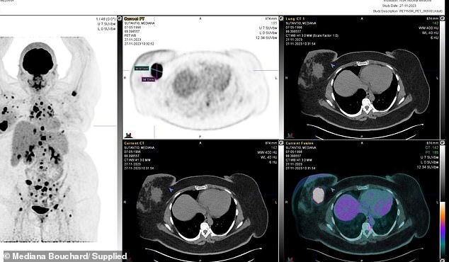 X-rays show that the cancer has spread beyond the breast to other organs in her body