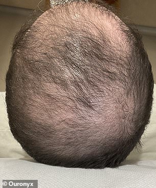 A 32-year-old client before microtransplantation