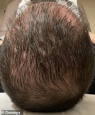 The 32-year-old client six months after microtransplantation