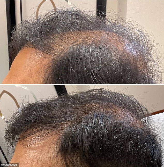 Micrografting also helped a 29-year-old man with his hair loss, which had started at a relatively young age. Pictured from top to bottom: before treatment and six months after