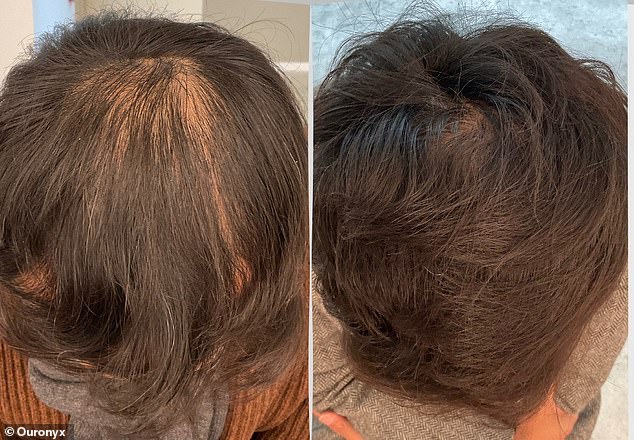 A 51-year-old man, who is a CEO, considered hair transplantation but decided against it due to his busy schedule and tried microtransplantation instead. Pictured from top to bottom: before treatment and six months after