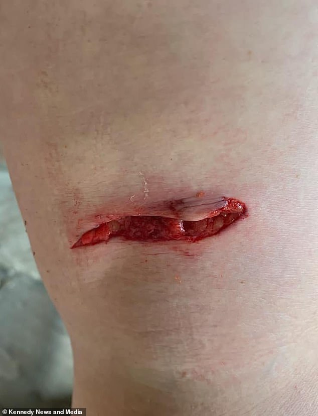 It wasn't until her husband, David, took a photo of the wound and showed her what appeared to be a 3-inch gash just above the back of her right knee that she realized the extent of her injury.