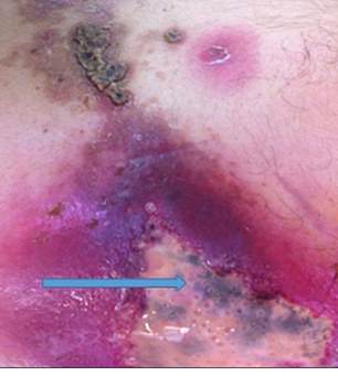 A 55-year-old man presented to the hospital with a serious case of a bacterial flesh-eating infection that had caused a huge ulcer on his torso