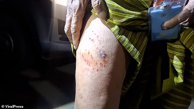 She had wounds on her leg from where the python had bitten her (photo)