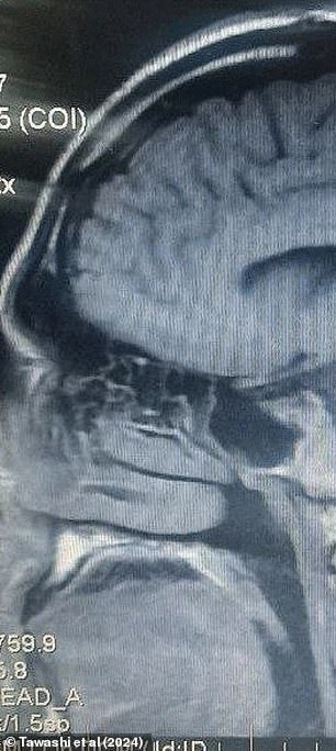 The image above shows the resolution of the man's encephalocele in his nasal cavity after surgery