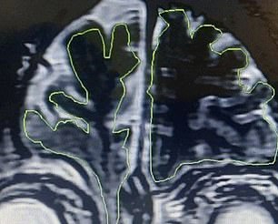 Above you see the encephalocele that has been pushed through the patient's skull into his nasal cavity