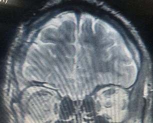 Above you see the patient's brain after removal of the encephalocele