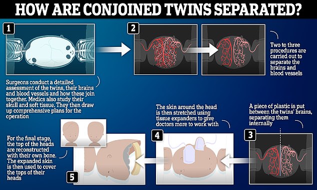 1726732263 511 British surgeons successfully separate conjoined twins in radical 14 hour operation