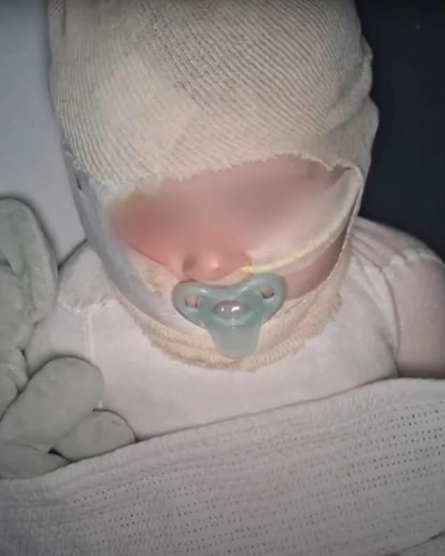 The nine-month-old baby (pictured) suffered severe burns to his face, upper body and arms and has undergone seven operations at Queensland Children's Hospital