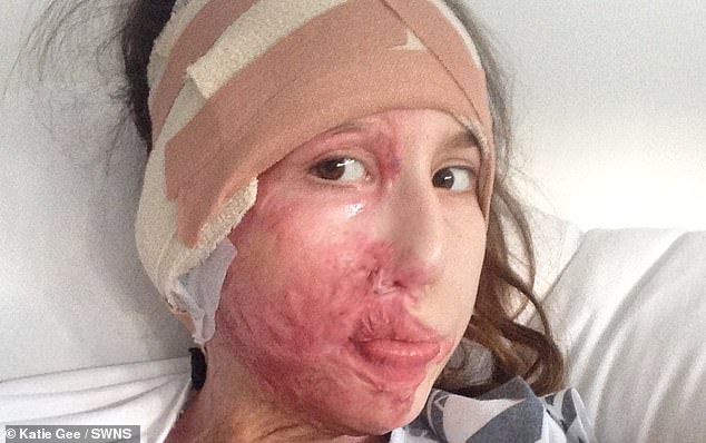 Pictured: Katie in hospital after acid attack by two random men in Stone Town, Tanzania