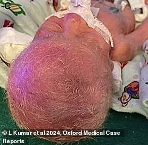 She also had soft, small hair all over her body that was light in color, doctors reported.