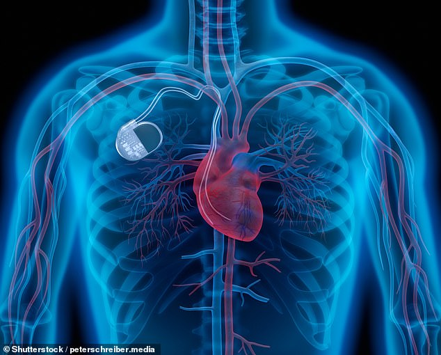 Traditional pacemakers use wires and a generator under the skin to keep the heart beating regularly. (Stock photo)