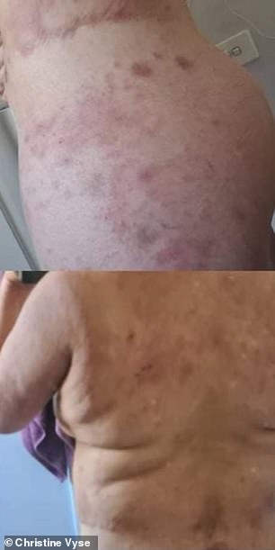 Her body was covered with severe eczema