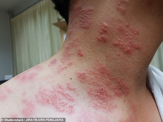 Shingles is a viral infection caused by the same virus responsible for chickenpox. Patients develop a rash of blisters that are painful and can be itchy (stock image)