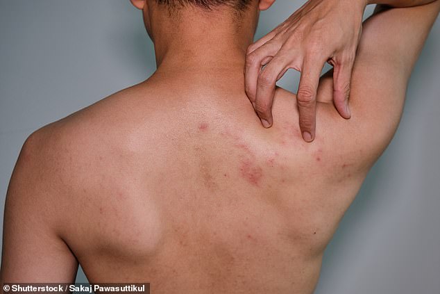 The expansion to include younger and immunocompromised patients in the National Immunization Program for the shingles vaccine will help people save up to $560 (stock image of a shingles rash on a man's back)