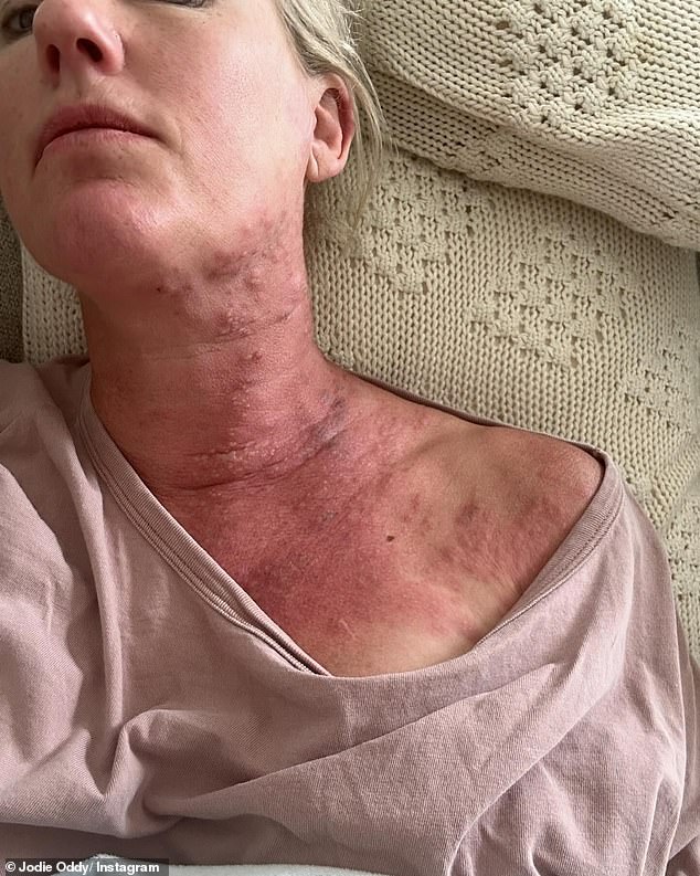 Jodie Oddy, who co-presents Nova 919's Adelaide breakfast show with Andrew Hayes, has opened up about her recent hellish holiday, which left her with shingles