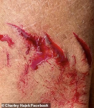 A bull shark bit the professional surfer's left leg