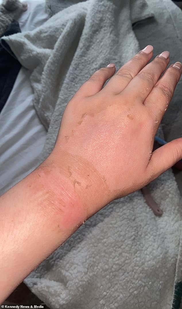 Experts recommend throwing away a hot water bottle after two years because the rubber breaks down and is likely to split. Pictured: Mrs. Hardy's dead, flaky skin on her hands.