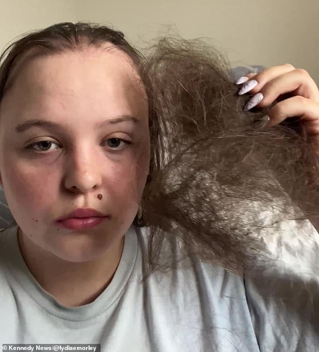 Within five months of being diagnosed with alopecia, Lydia lost 80 percent of her hair