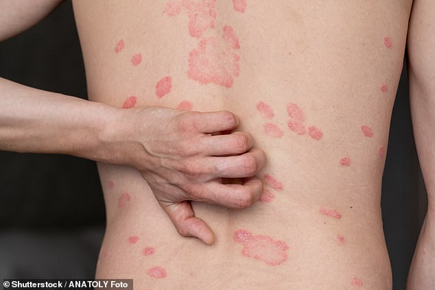 Psoriasis leaves sufferers covered in unsightly red, scaly patches and affects one in 50 people in Britain