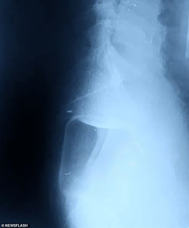 X-rays show the glass container removed by doctors, along with a condom and lubricant