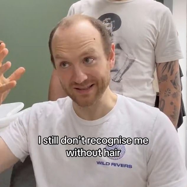 A bald man has become unrecognisable after a phenomenal hair transformation left him with a full head of healthy hair