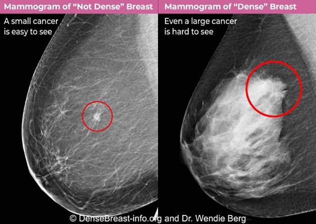 Fatty tissue, which appears dark on a mammogram, makes it easier to spot tumors because they are more noticeable than dense, fibrous tissue. Scan courtesy of Densebreast-info.org