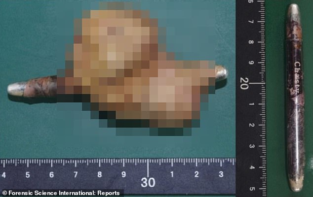 The above image from the patient's autopsy shows the tube of eyeliner entering a large bladder stone, which likely occurred when the eyeliner entered and injured the bladder.