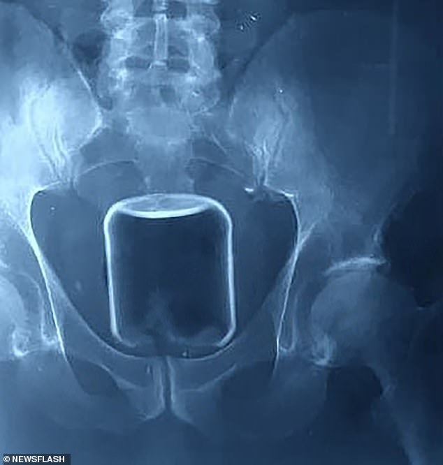 X-rays from the hospital show that the glass jar was lodged high in the man's anus and went up into his rectum