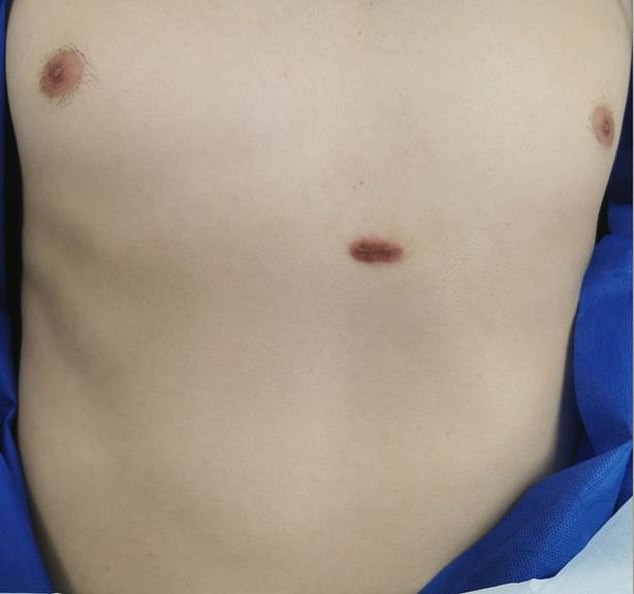 In a case report published in the BMJ, doctors at Beaumont Hospital in Dublin reported that a man in his 20s was referred to them requesting removal of a mole measuring almost an inch long on his chest.