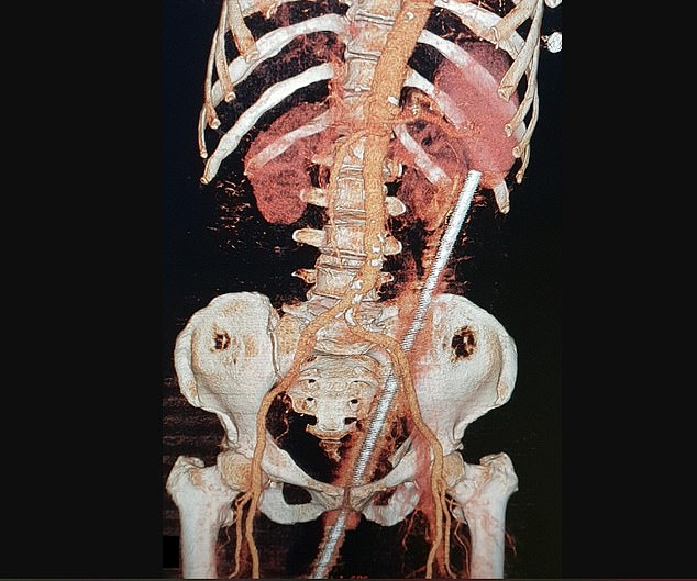 The CT scan shows that the rusty metal rod bypassed crucial blood vessels and organs and miraculously left no serious damage