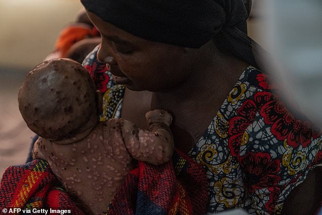 A woman cares for her baby who suffers from a severe form of mpox in eastern Democratic Republic of Congo